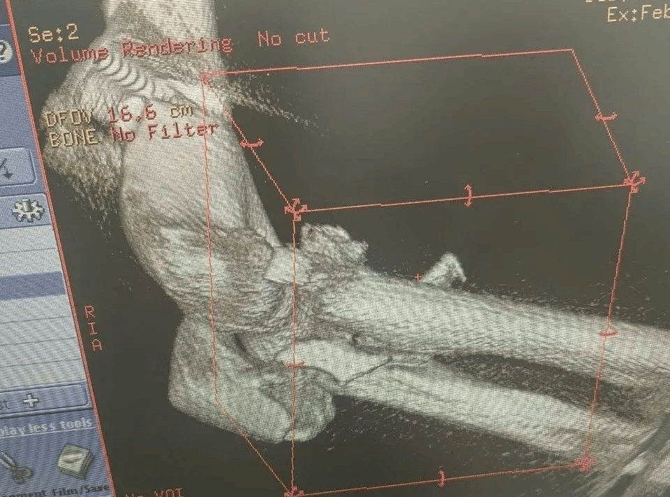 Медики в Ставрополе спасли мужчину, упавшего с 6-метровой высоты Минздрав Ставрополья